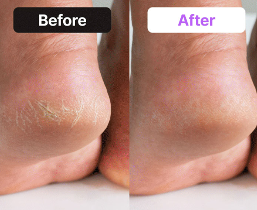 Baren Shea Butter Sleeping Heel Patch - noční náplasti na paty s bambuckým máslem 10 kusů (3)